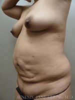 Revision Liposuction