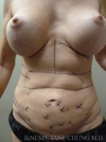 Revision Liposuction