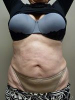 Revision Liposuction