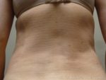 Revision Liposuction