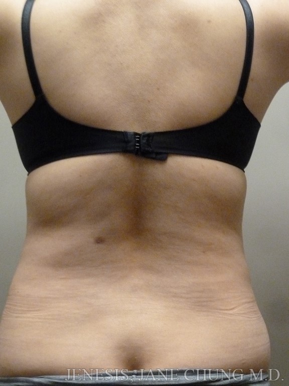 Revision Liposuction