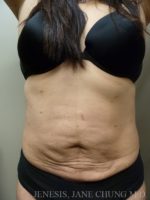 Revision Liposuction