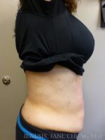 Revision Liposuction