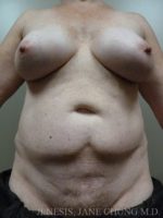 Revision Liposuction