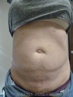 Revision Liposuction