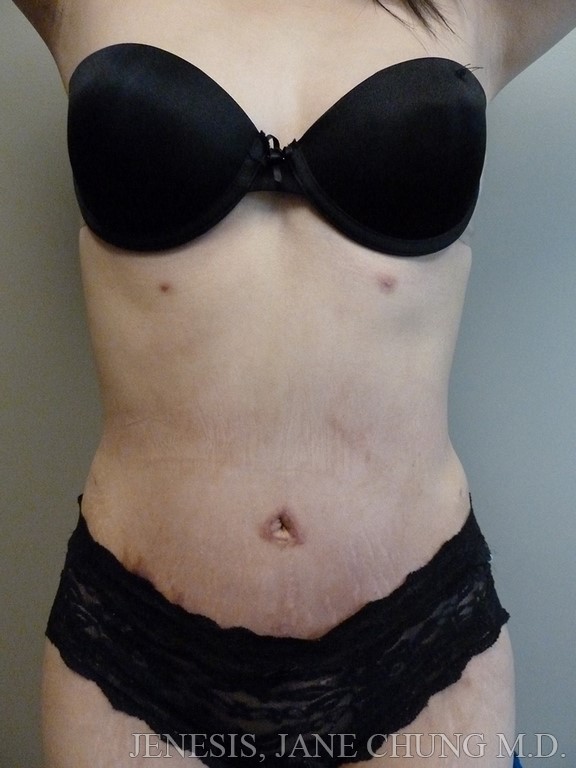 Revision Liposuction