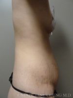 Revision Liposuction