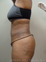 Revision Liposuction