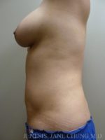 Revision Liposuction