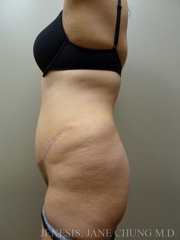 Revision Liposuction