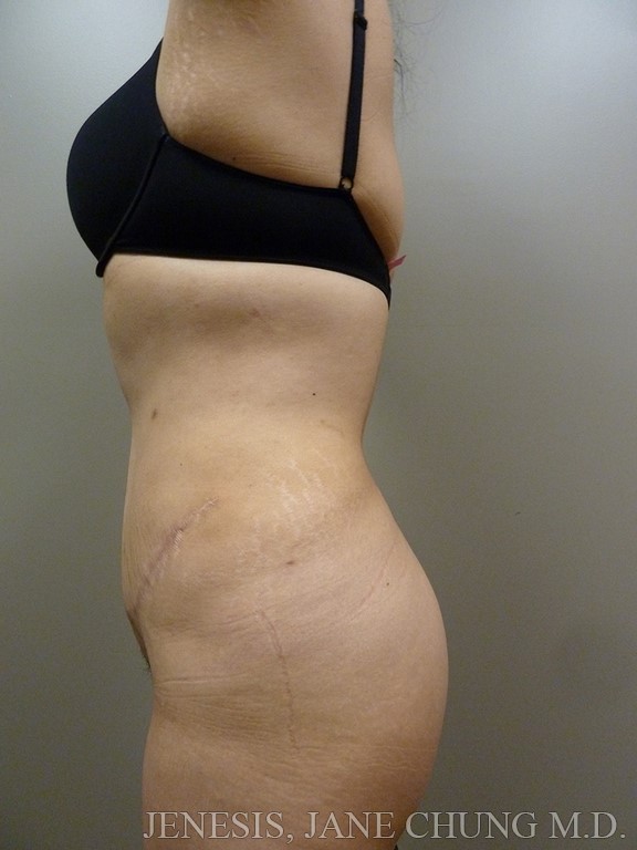 Revision Liposuction