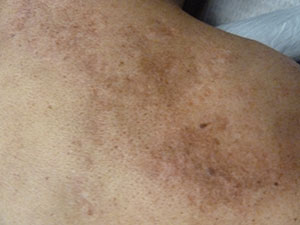 PiQo4 Melasma