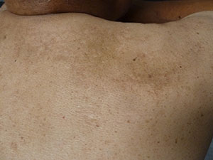 PiQo4 Melasma