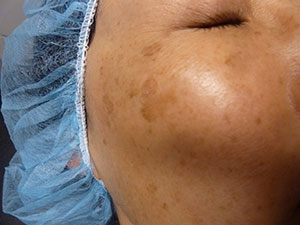 PiQo4 Melasma