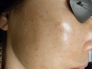 PiQo4 Melasma