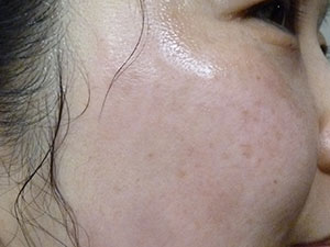 PiQo4 Melasma