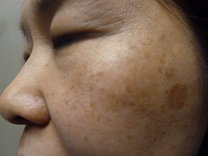 PiQo4 Melasma