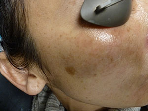 PiQo4 Melasma