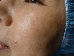 PiQo4 Melasma