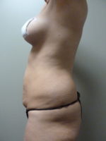 Non-Surgical Buttlift