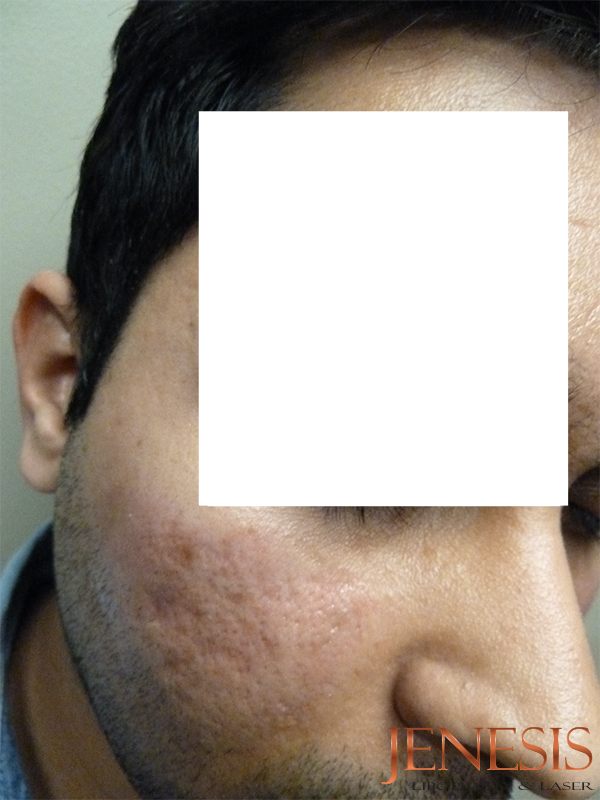 Bellafill Acne Scar