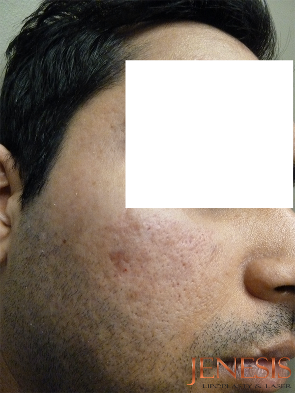 Bellafill Acne Scar