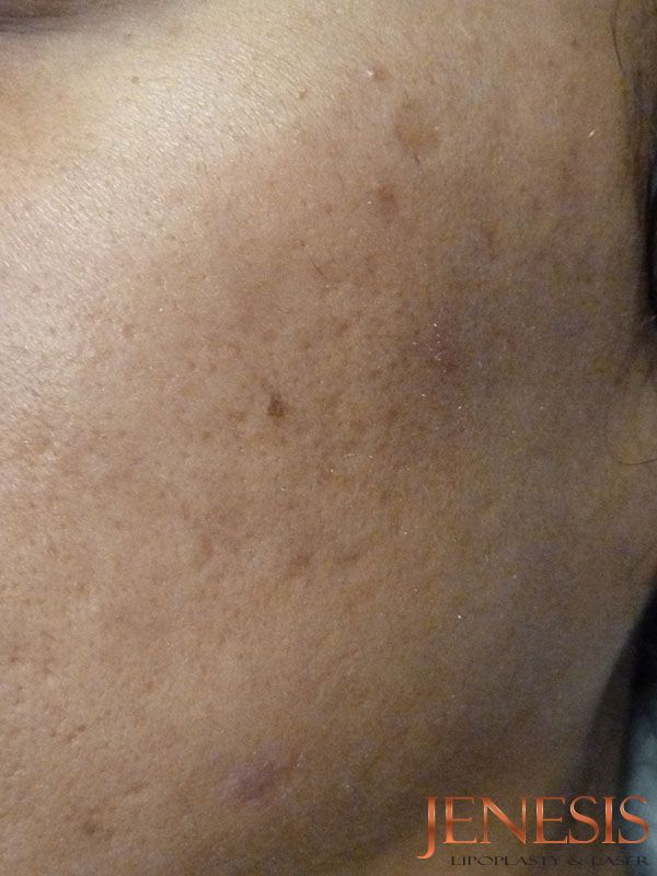 Bellafill Acne Scar