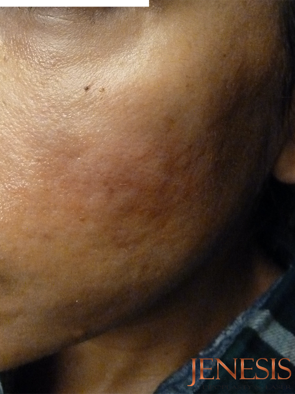 Bellafill Acne Scar