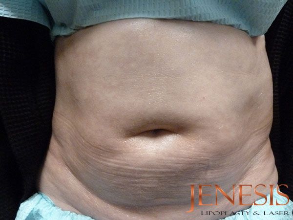 Injectable Lipo