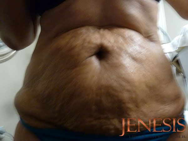 Injectable Lipo