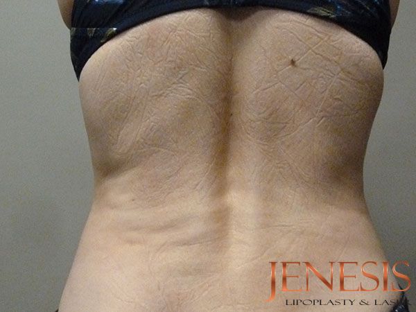 Injectable Lipo
