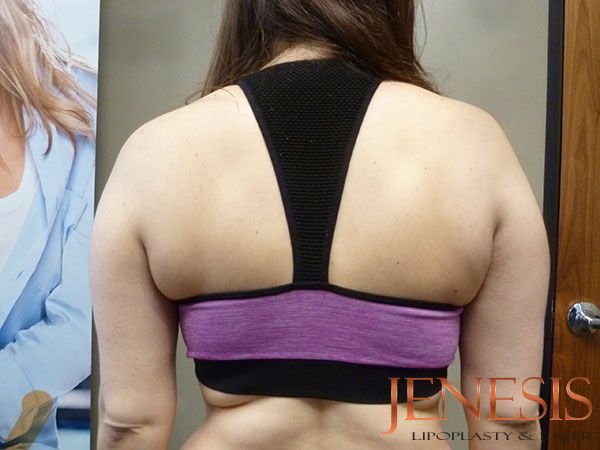 Injectable Lipo
