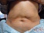 Injectable Lipo
