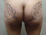 Radiesse Butt