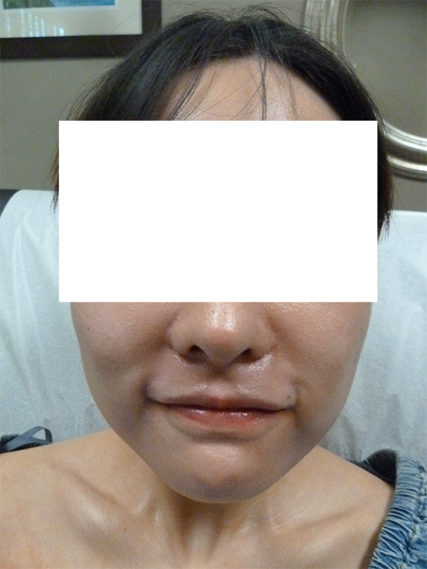 Botox Jaw