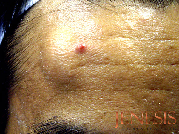 CYST LIPOMA