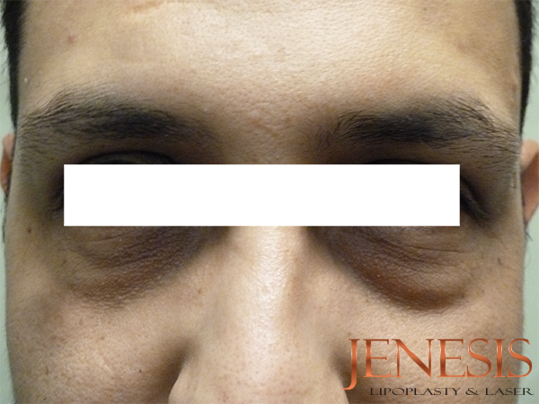 Non-surgical Dark circle removal with Filler