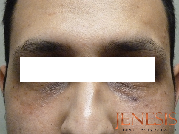 Non-surgical Dark circle removal with Filler