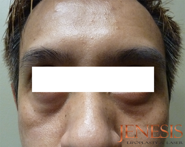 Non-surgical Dark circle removal with Filler