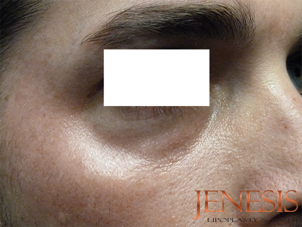 Non-surgical Dark circle removal with Filler