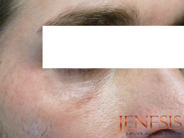 Non-surgical Dark circle removal with Filler