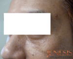 Non-surgical Dark circle removal with Filler