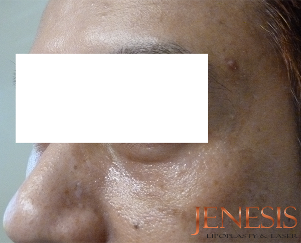 Non-surgical Dark circle removal with Filler