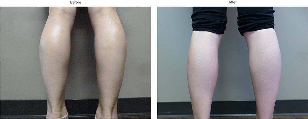 Botox for Calves Before & After Results