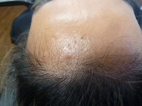 PiQo4 Melasma