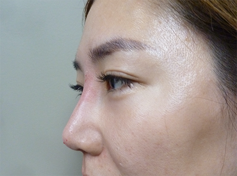 Non Surgical Nose Job