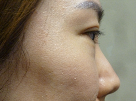Non Surgical Nose Job