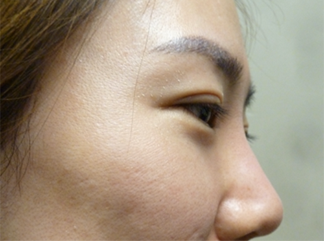 Non Surgical Nose Job