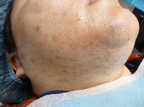 PiQo4 Melasma