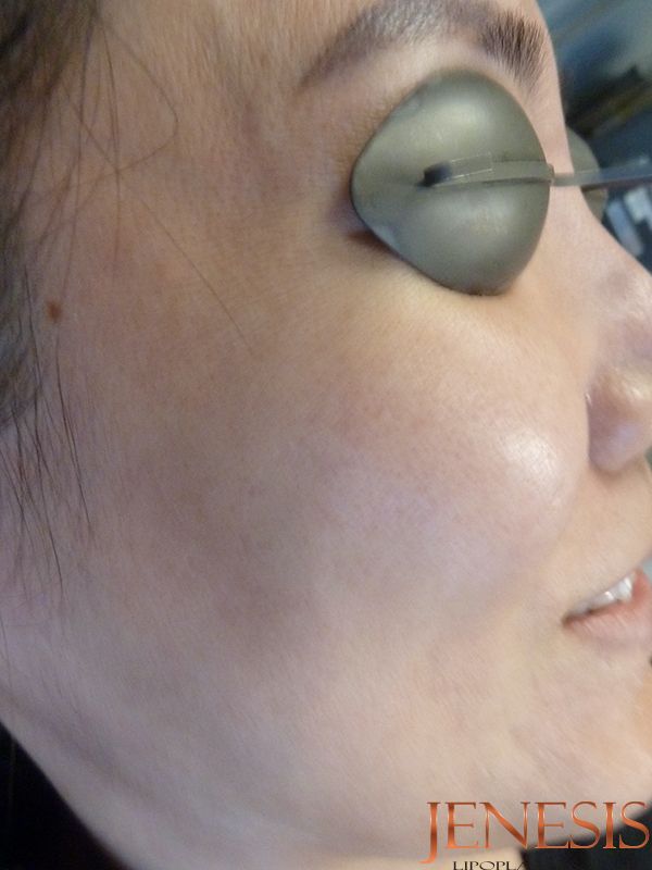 Co2 Laser Resurfacing